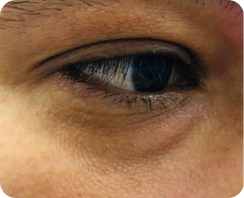 acido hialuronico en ojeras antes
