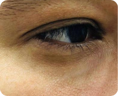 acido hialuronico en ojeras despues