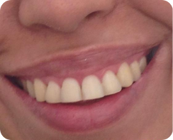 sonrisa gingival antes