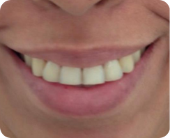 sonrisa gingival despues