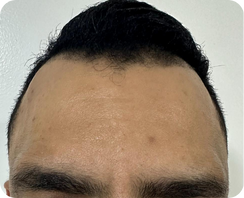 toxina botulinica despues