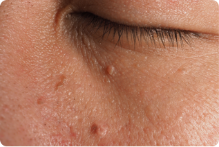 tratamiento de lesiones cutaneas