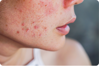 tratamientos dermatologicos