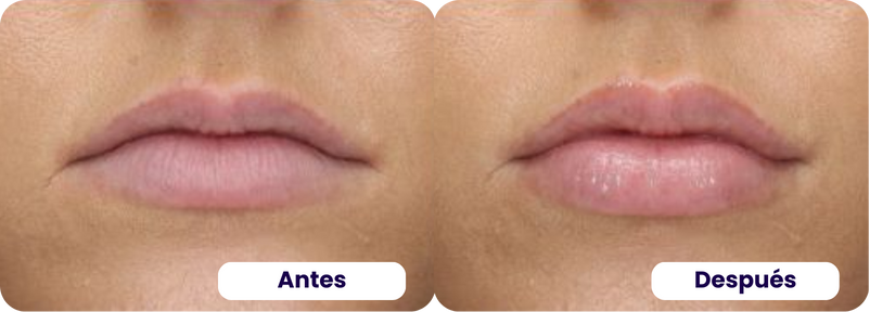 acido hialurónico antes y despues 1