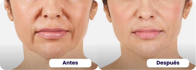 acido hialurónico antes y despues 2