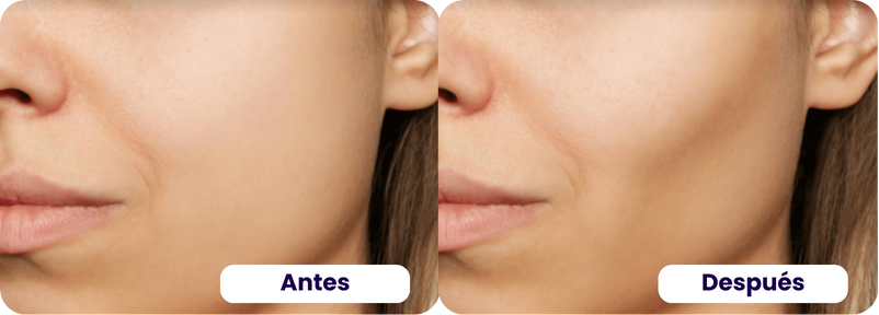 acido hialurónico antes y despues 3