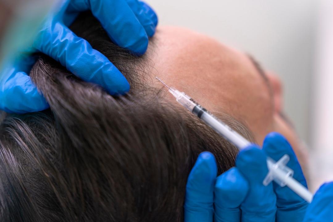 tratamiento con bótox